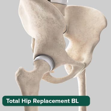 Arthroplastie totale de la hanche (B/L))