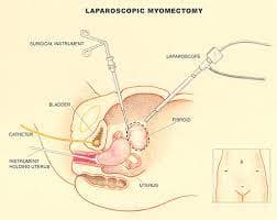 Laparoscopic Cystectomy & Myomectomy